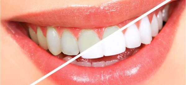 5 Diş Beyazlatma Yöntemi